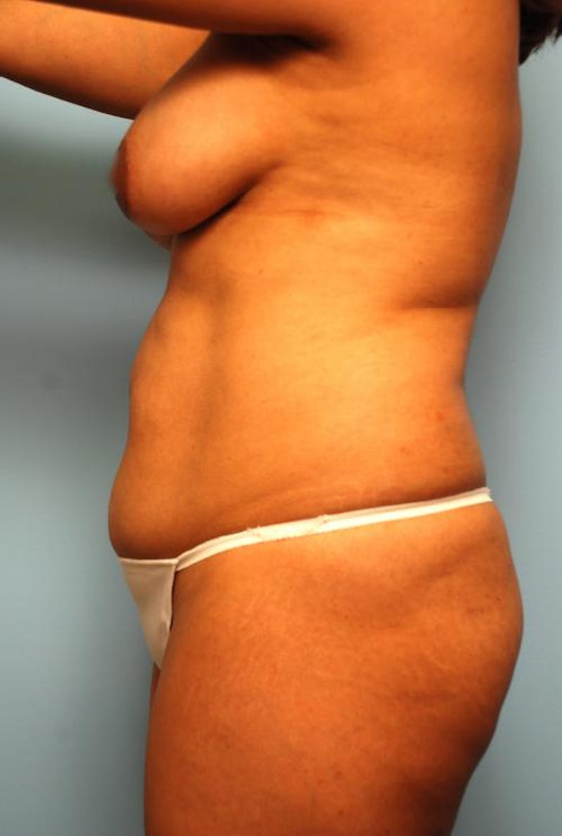 Liposuction Before & After Gallery - Patient 287385 - Image 9