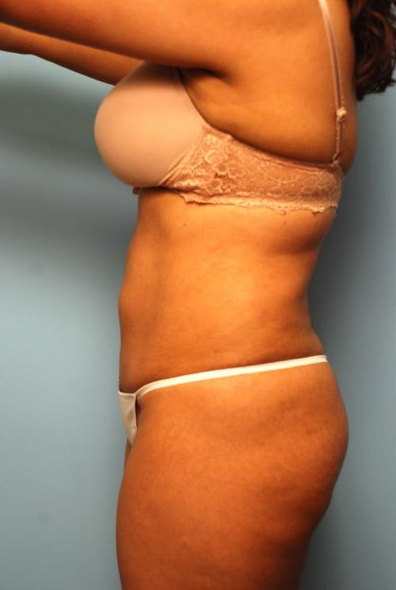 Liposuction Before & After Gallery - Patient 287385 - Image 10