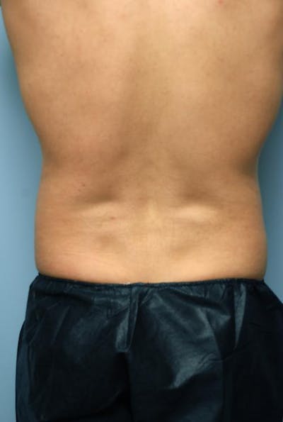 Liposuction Before & After Gallery - Patient 130160 - Image 1