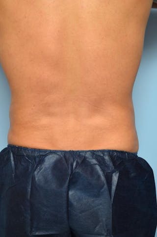 Liposuction Before & After Gallery - Patient 369255 - Image 2