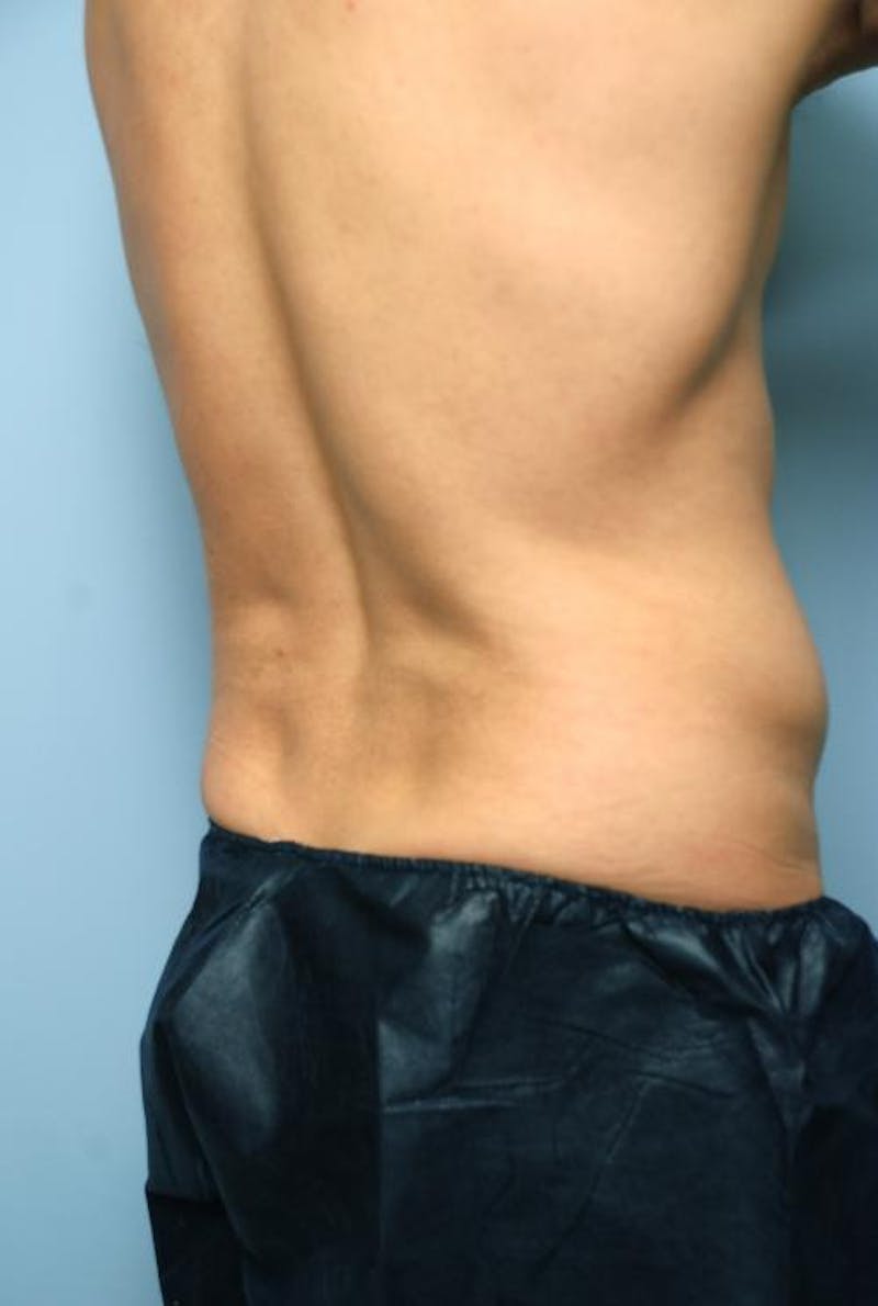 Liposuction Before & After Gallery - Patient 369255 - Image 3
