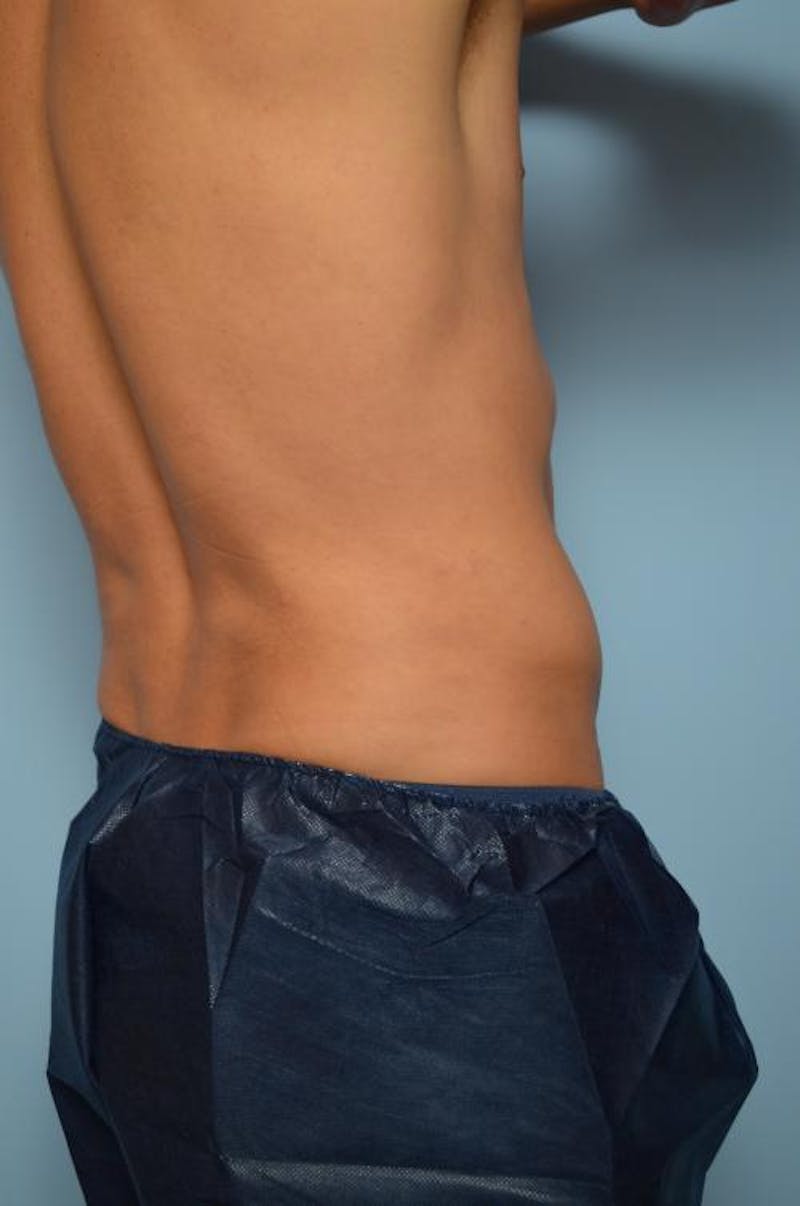 Liposuction Before & After Gallery - Patient 369255 - Image 4