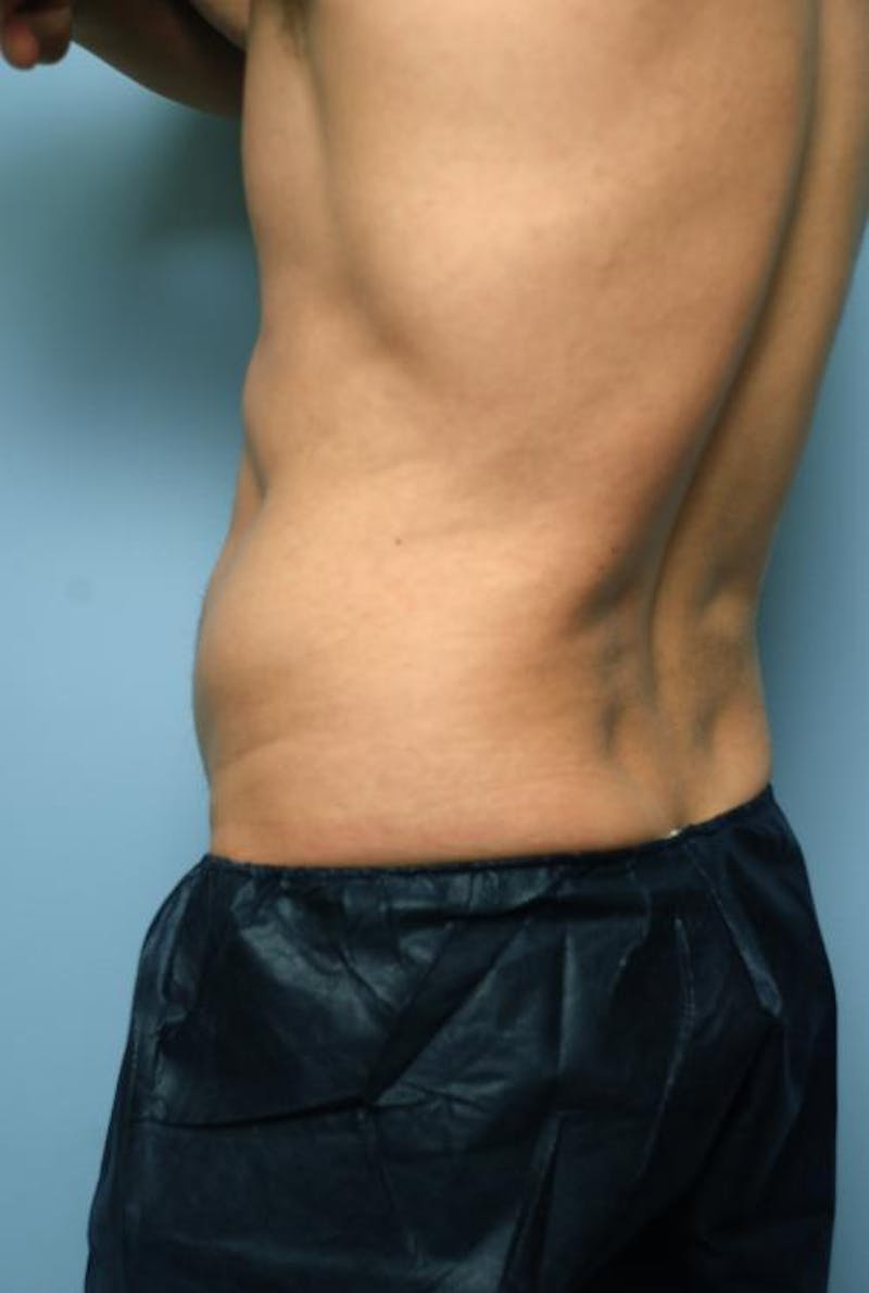 Liposuction Before & After Gallery - Patient 369255 - Image 5