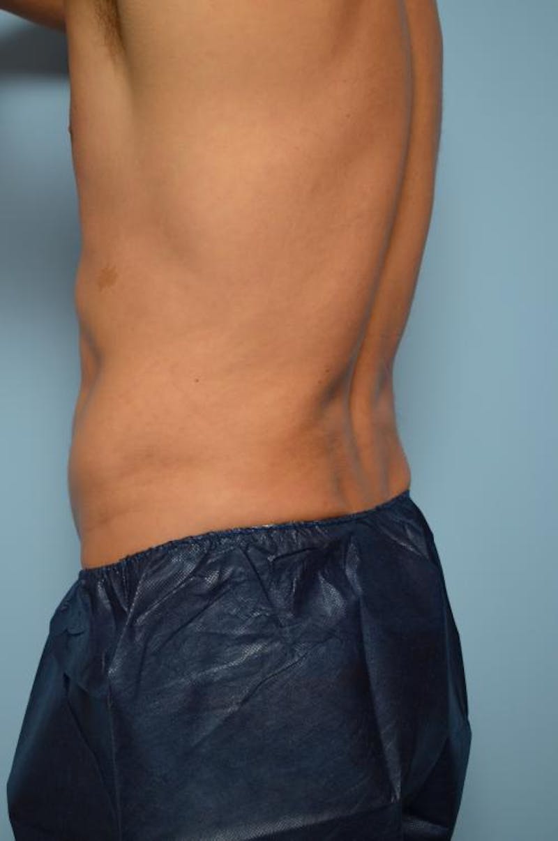 Liposuction Before & After Gallery - Patient 369255 - Image 6