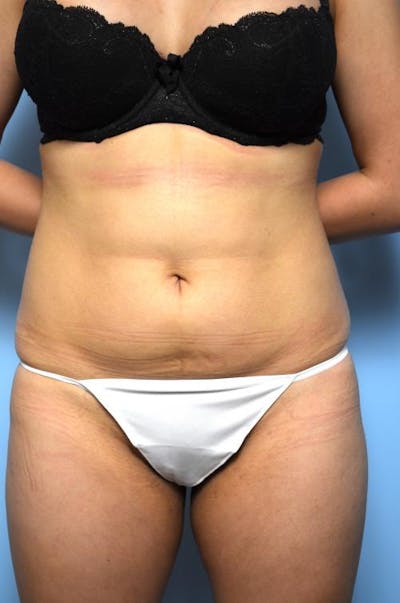 Liposuction Before & After Gallery - Patient 145017 - Image 1