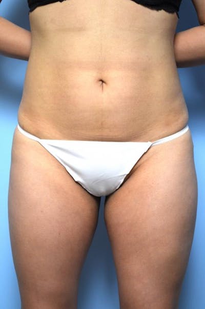 Liposuction Before & After Gallery - Patient 145017 - Image 2