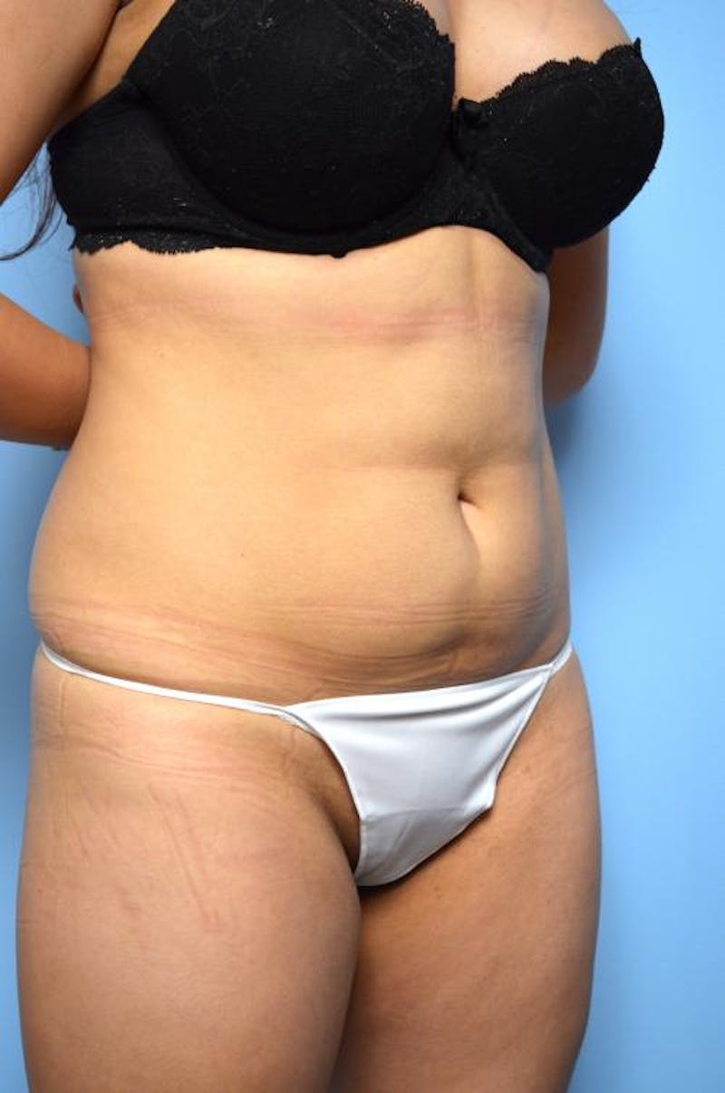 Liposuction Before & After Gallery - Patient 325963 - Image 3