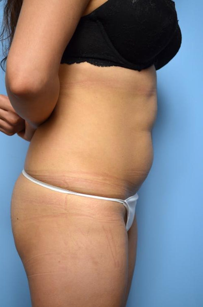 Liposuction Before & After Gallery - Patient 325963 - Image 5