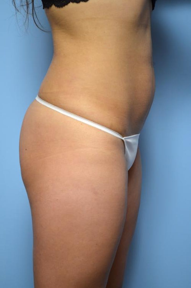 Liposuction Before & After Gallery - Patient 325963 - Image 6