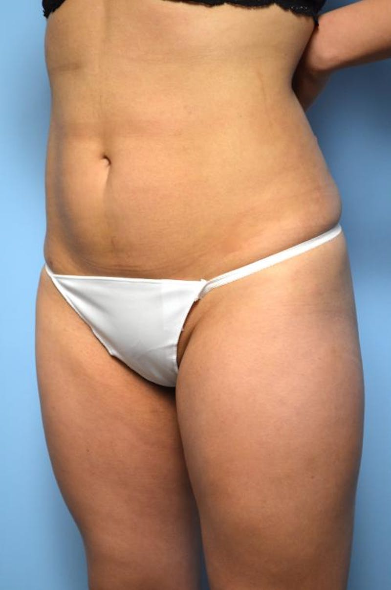 Liposuction Before & After Gallery - Patient 325963 - Image 8