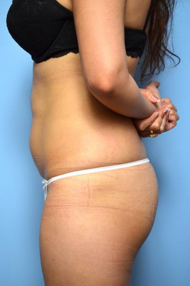 Liposuction Before & After Gallery - Patient 325963 - Image 9