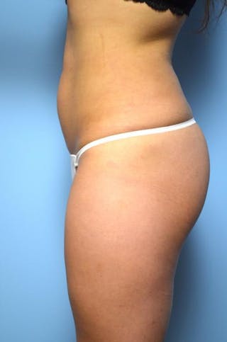 Liposuction Before & After Gallery - Patient 325963 - Image 10