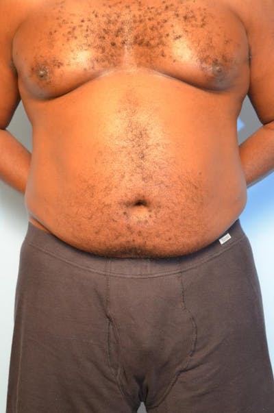 Liposuction Before & After Gallery - Patient 932478 - Image 1