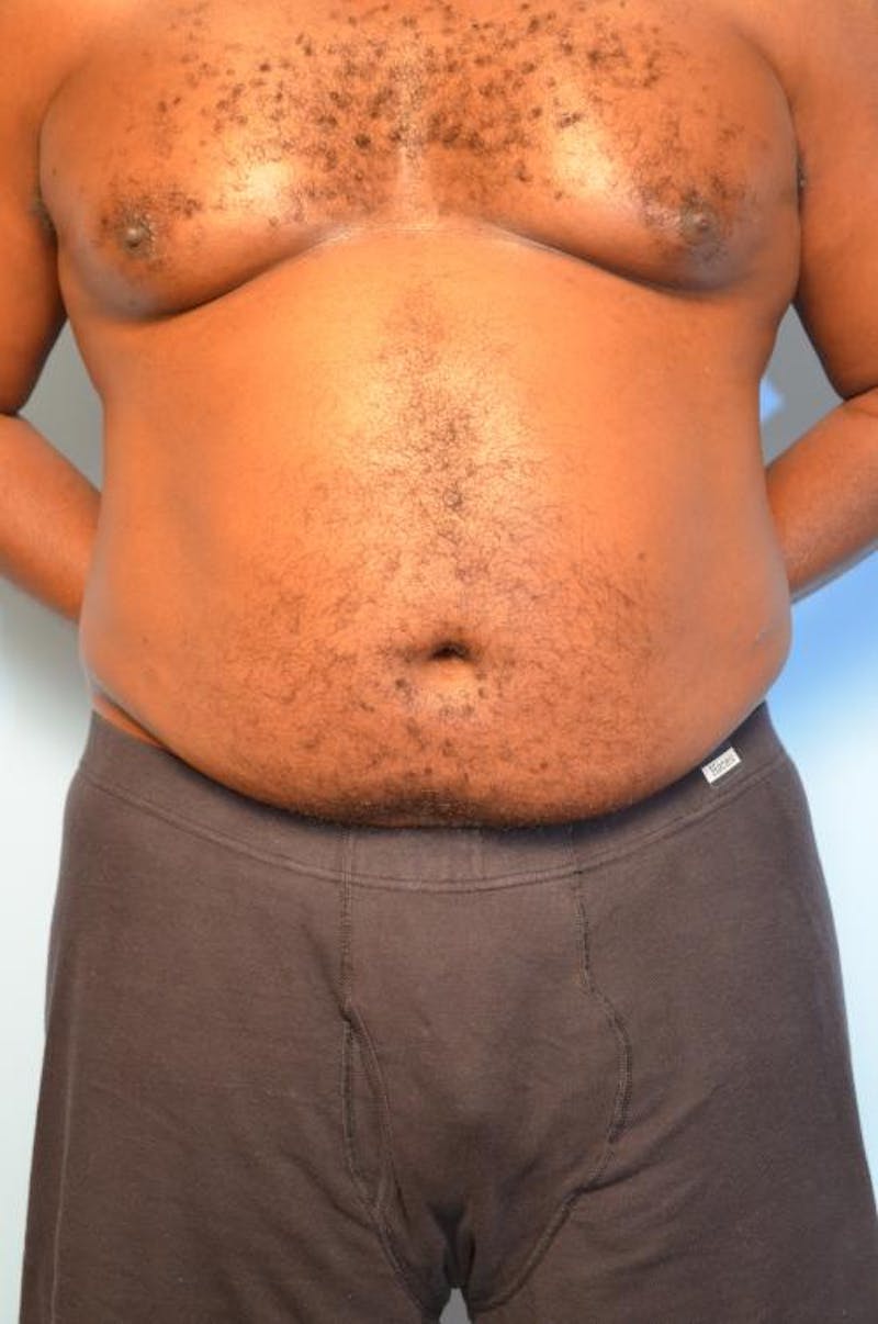Liposuction Before & After Gallery - Patient 277591 - Image 1