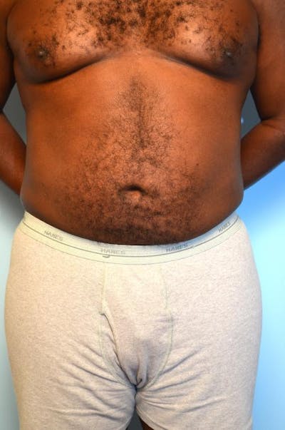 Liposuction Before & After Gallery - Patient 932478 - Image 2