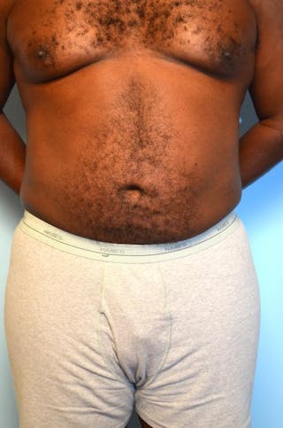 Liposuction Before & After Gallery - Patient 277591 - Image 2