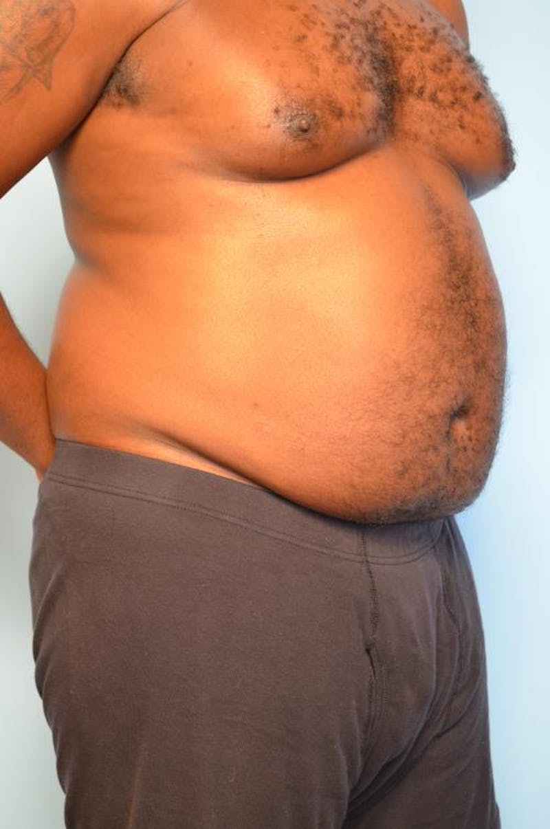 Liposuction Before & After Gallery - Patient 277591 - Image 3