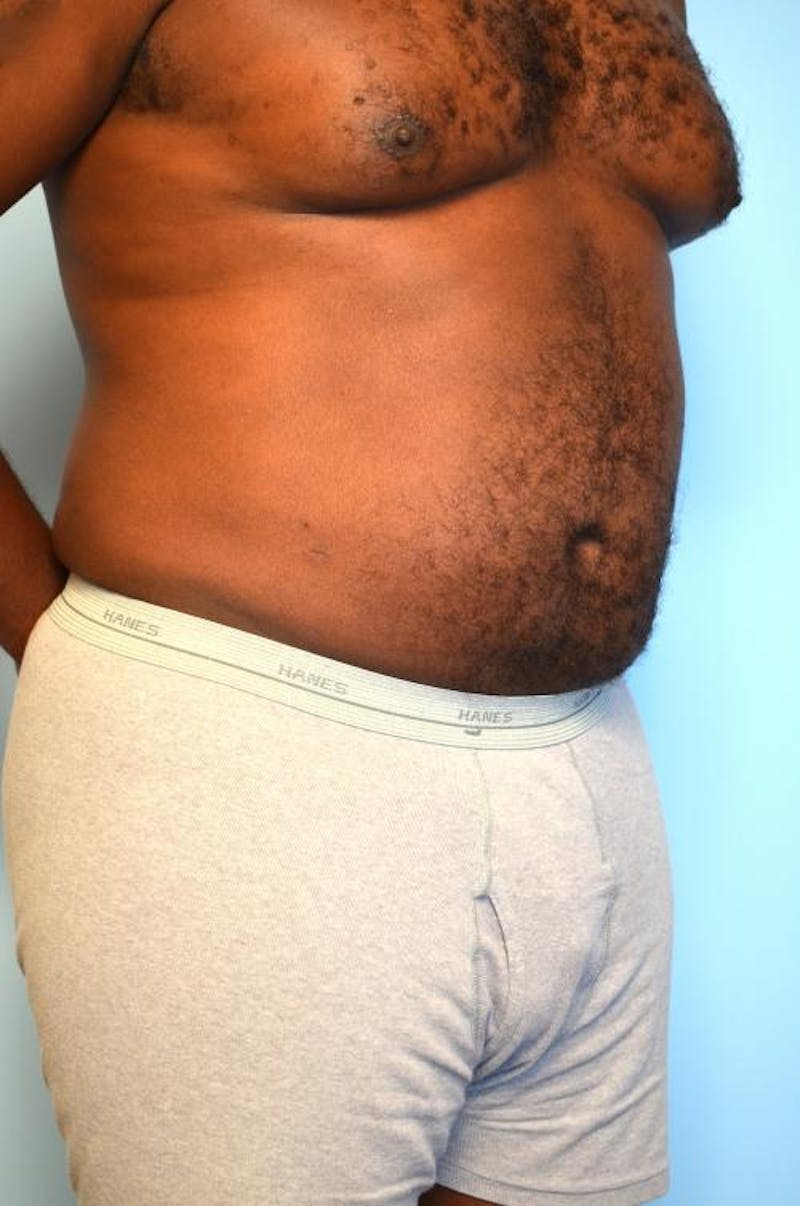 Liposuction Before & After Gallery - Patient 277591 - Image 4