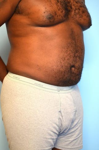 Liposuction Before & After Gallery - Patient 277591 - Image 4