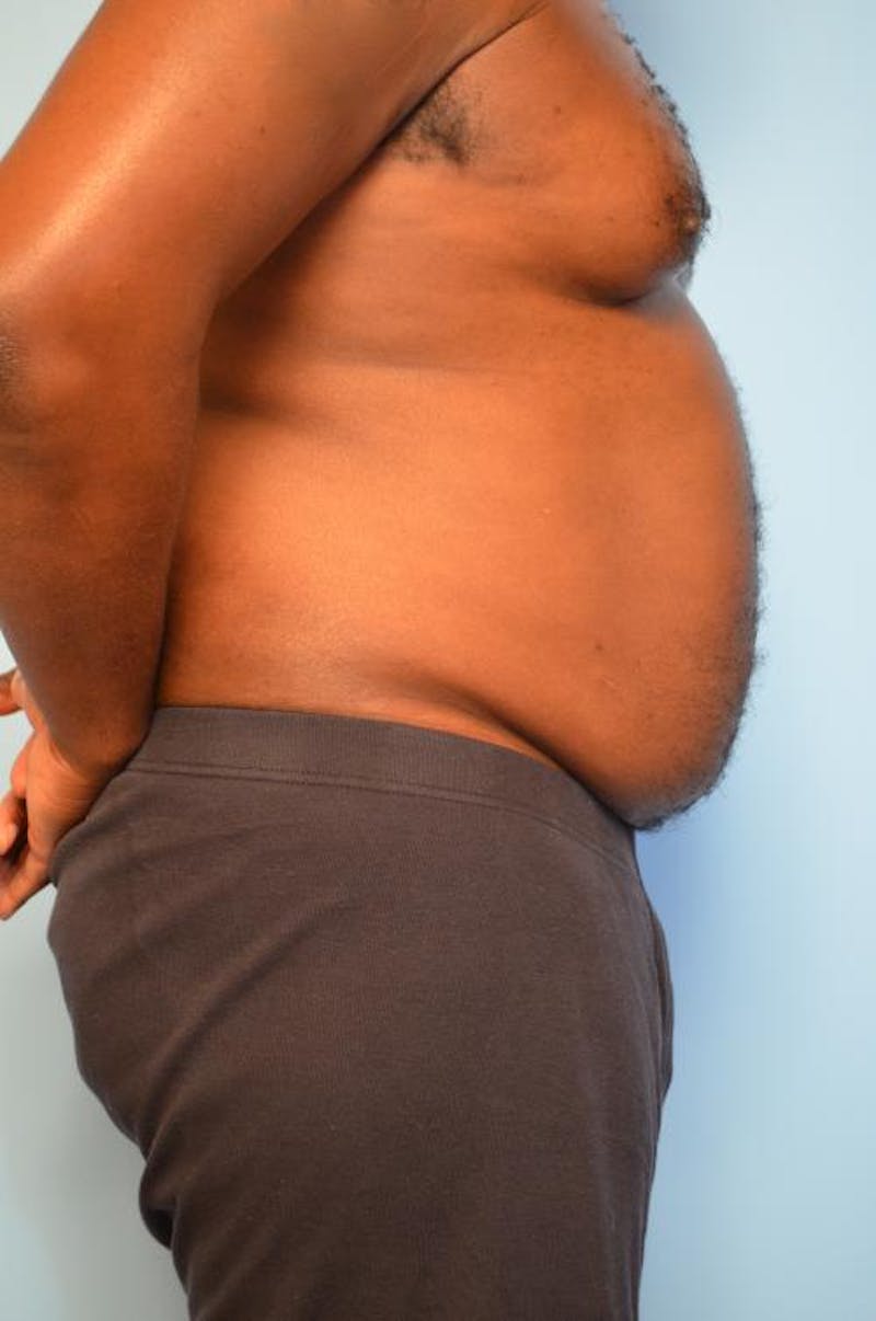 Liposuction Before & After Gallery - Patient 277591 - Image 5
