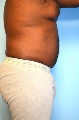 Liposuction Before & After Gallery - Patient 277591 - Image 6