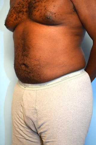 Liposuction Before & After Gallery - Patient 277591 - Image 8