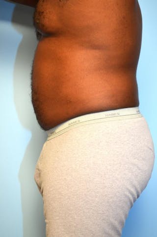 Liposuction Before & After Gallery - Patient 277591 - Image 10