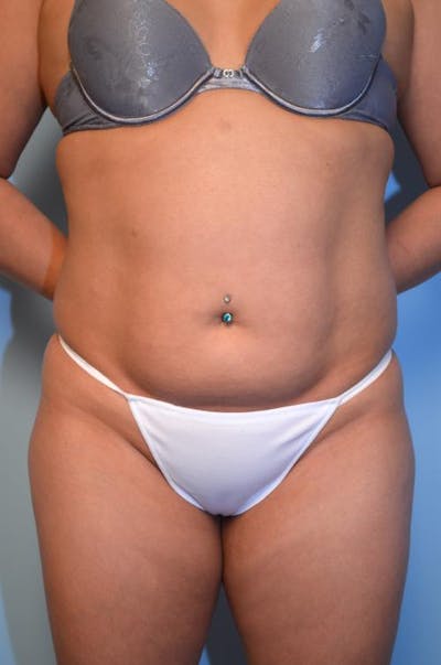 Liposuction Before & After Gallery - Patient 230033 - Image 1
