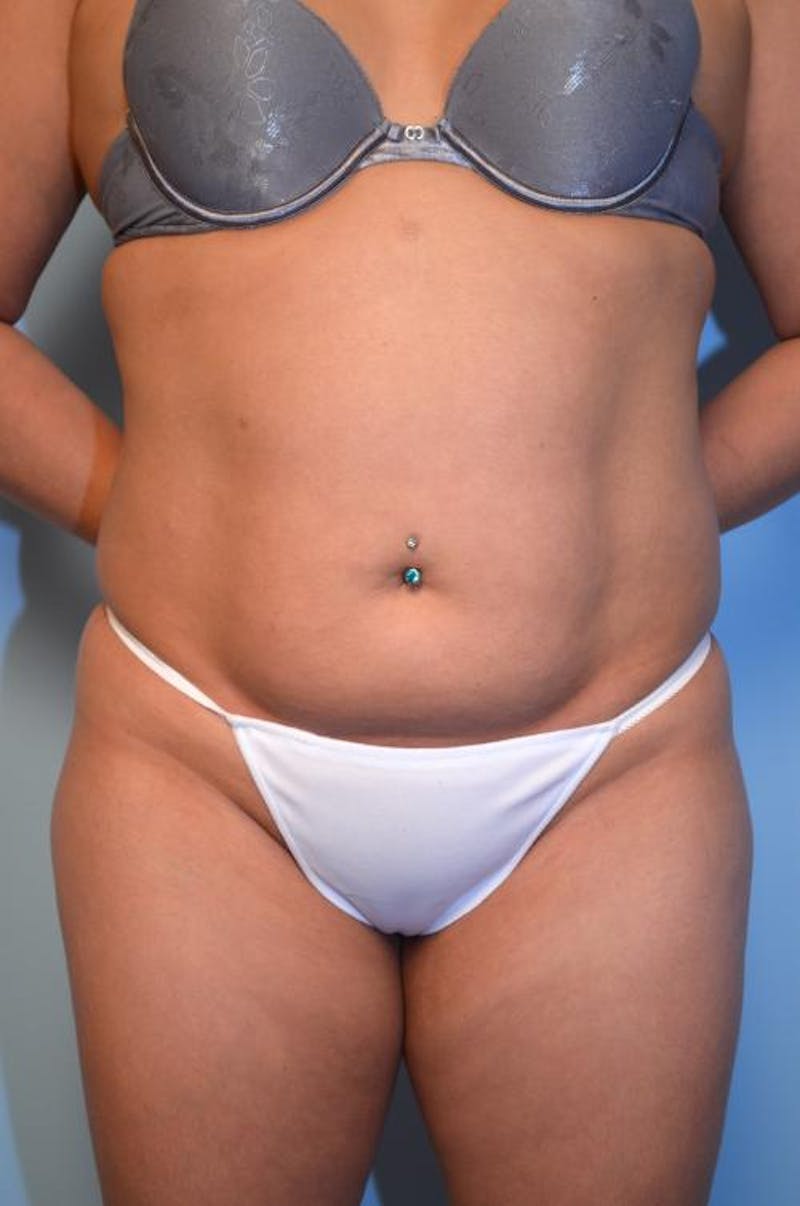 Liposuction Before & After Gallery - Patient 152079 - Image 1