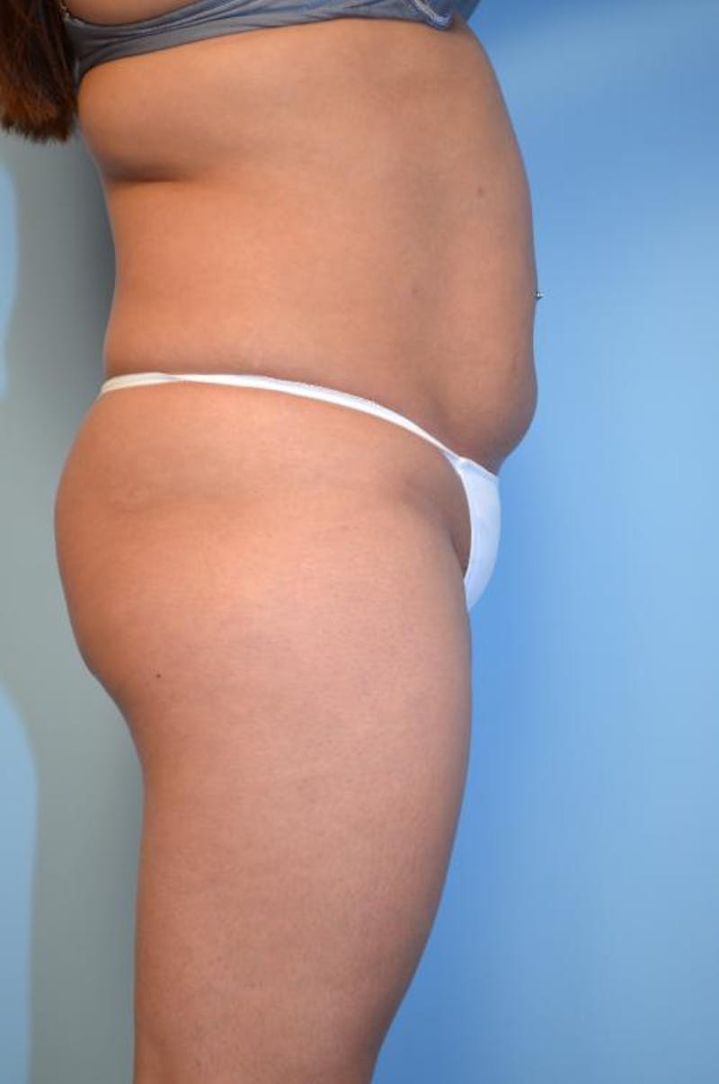 Liposuction Before & After Gallery - Patient 152079 - Image 5