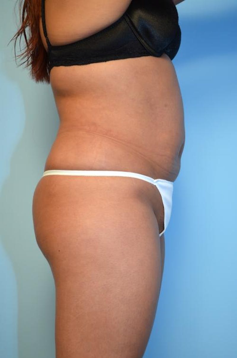 Liposuction Before & After Gallery - Patient 152079 - Image 6