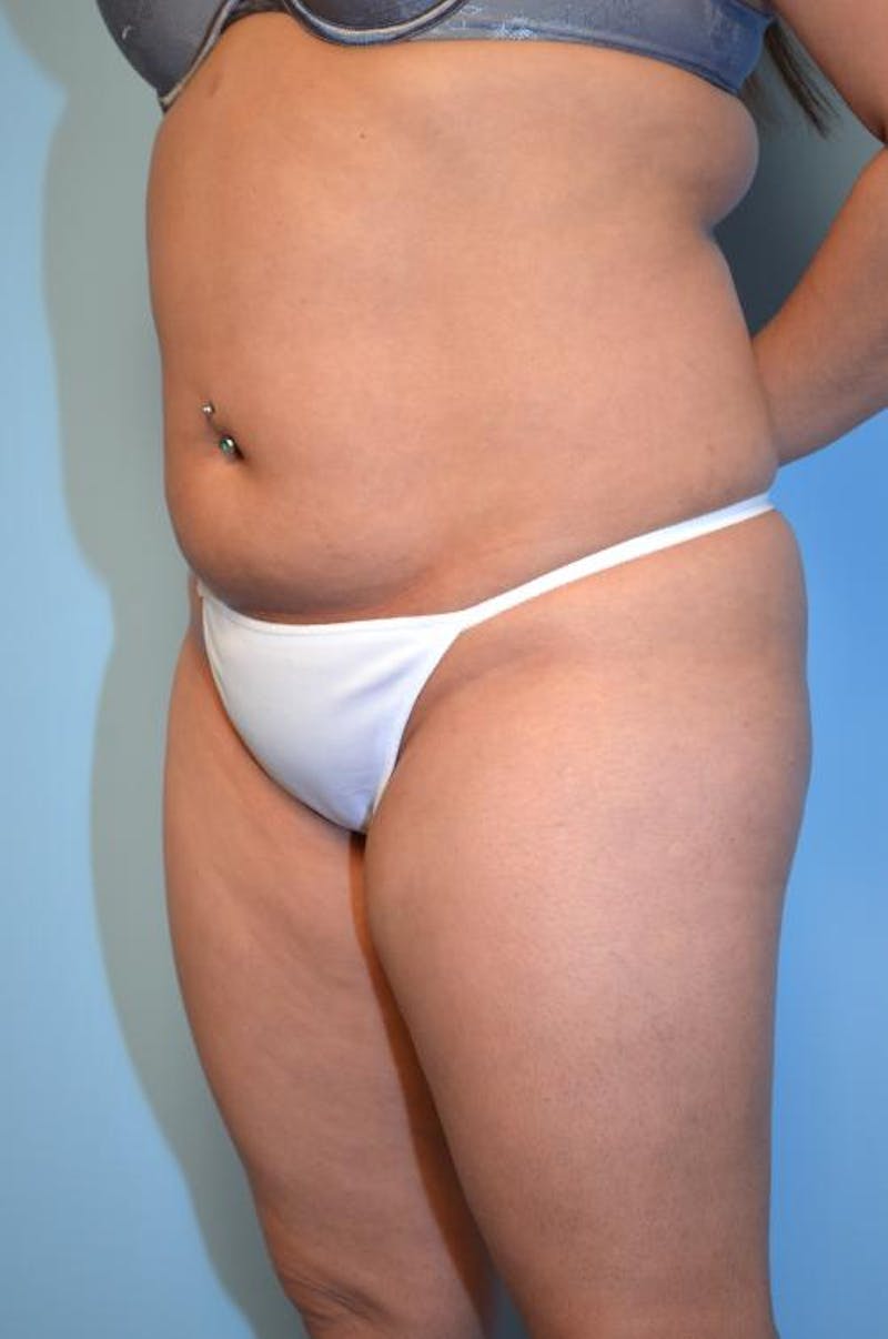 Liposuction Before & After Gallery - Patient 152079 - Image 7