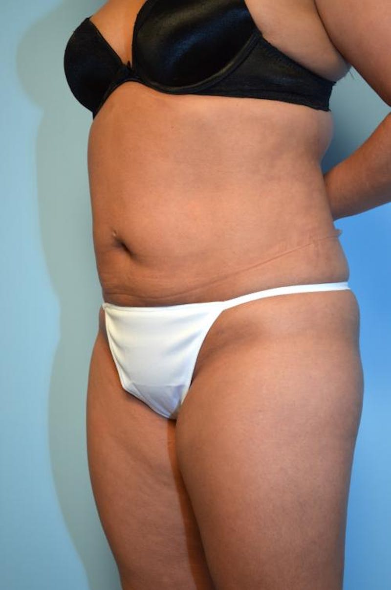 Liposuction Before & After Gallery - Patient 152079 - Image 8