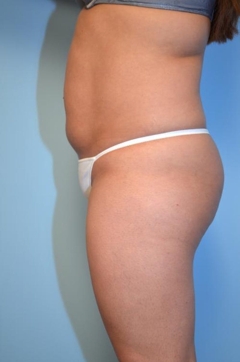 Liposuction Before & After Gallery - Patient 152079 - Image 9