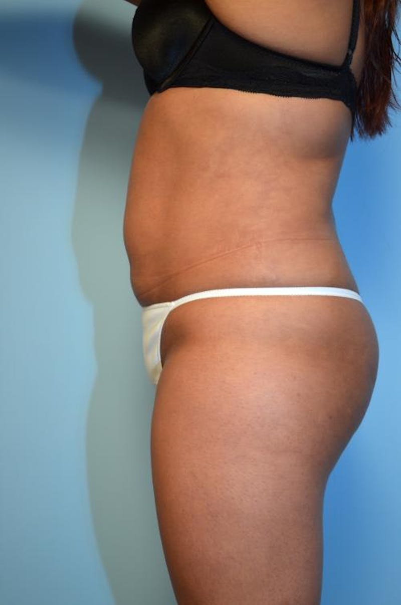 Liposuction Before & After Gallery - Patient 152079 - Image 10
