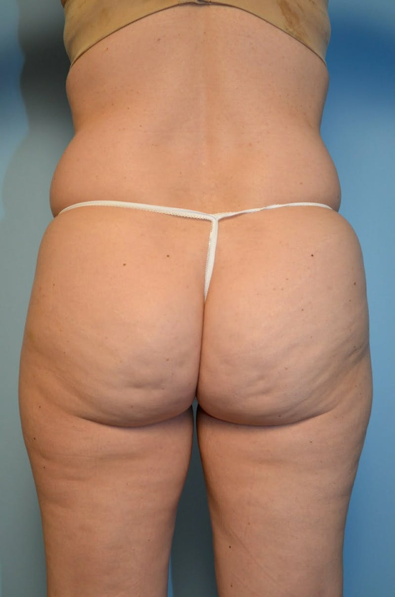 Liposuction Before & After Gallery - Patient 920194 - Image 7
