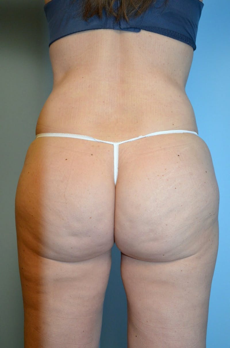 Liposuction Before & After Gallery - Patient 920194 - Image 8