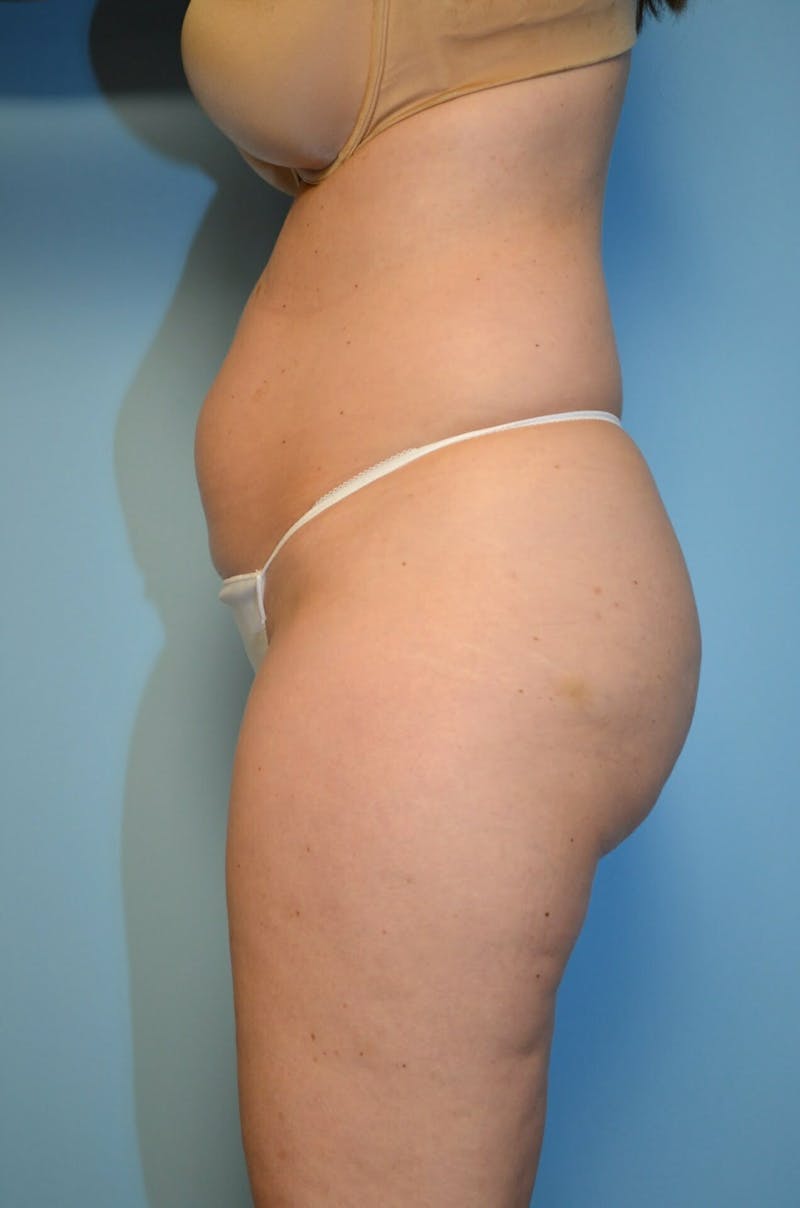 Liposuction Before & After Gallery - Patient 920194 - Image 9