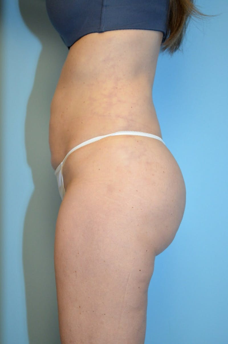 Liposuction Before & After Gallery - Patient 920194 - Image 10