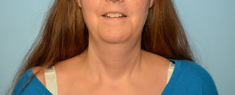 Liposuction Before & After Gallery - Patient 705216 - Image 1