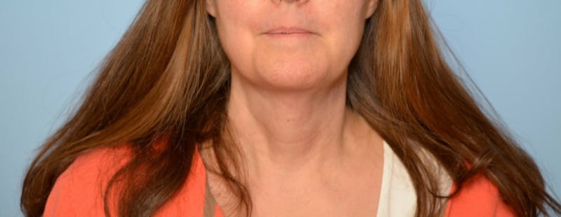 Liposuction Before & After Gallery - Patient 705216 - Image 2