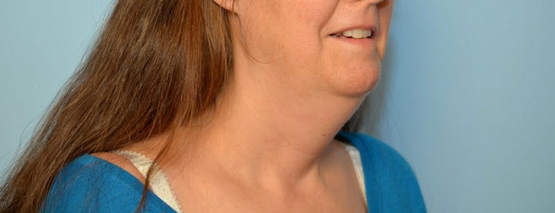 Liposuction Before & After Gallery - Patient 705216 - Image 3