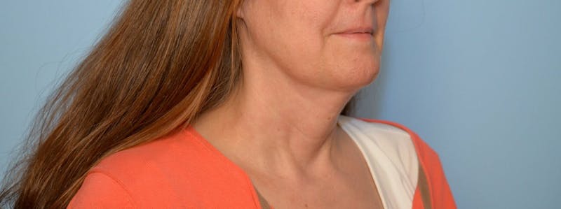 Liposuction Before & After Gallery - Patient 705216 - Image 4