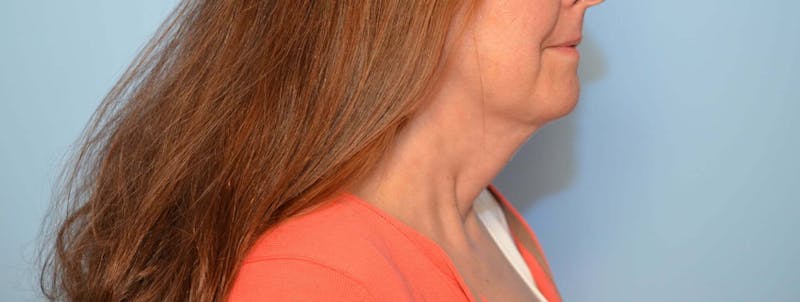 Liposuction Before & After Gallery - Patient 705216 - Image 6