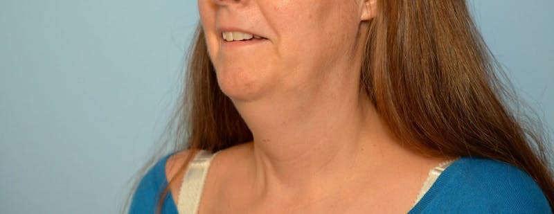 Liposuction Before & After Gallery - Patient 705216 - Image 7