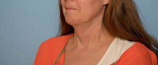 Liposuction Before & After Gallery - Patient 705216 - Image 8