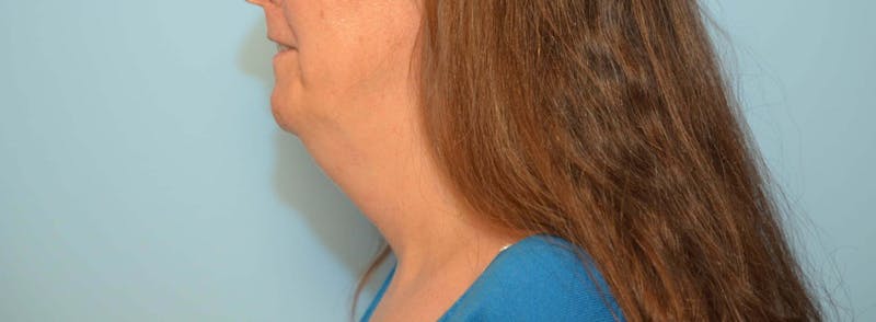 Liposuction Before & After Gallery - Patient 705216 - Image 9