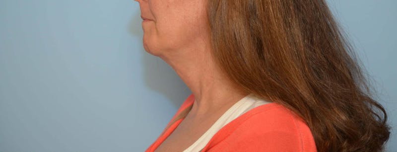 Liposuction Before & After Gallery - Patient 705216 - Image 10