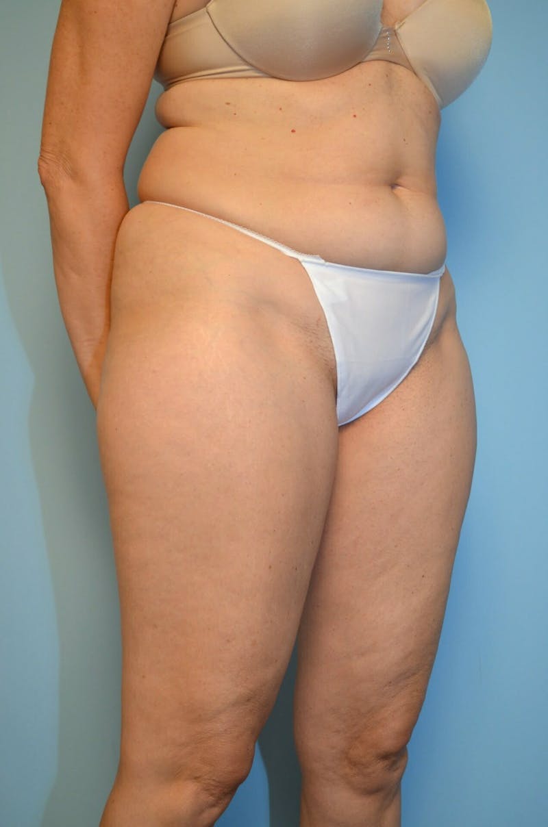 Liposuction Before & After Gallery - Patient 986940 - Image 3