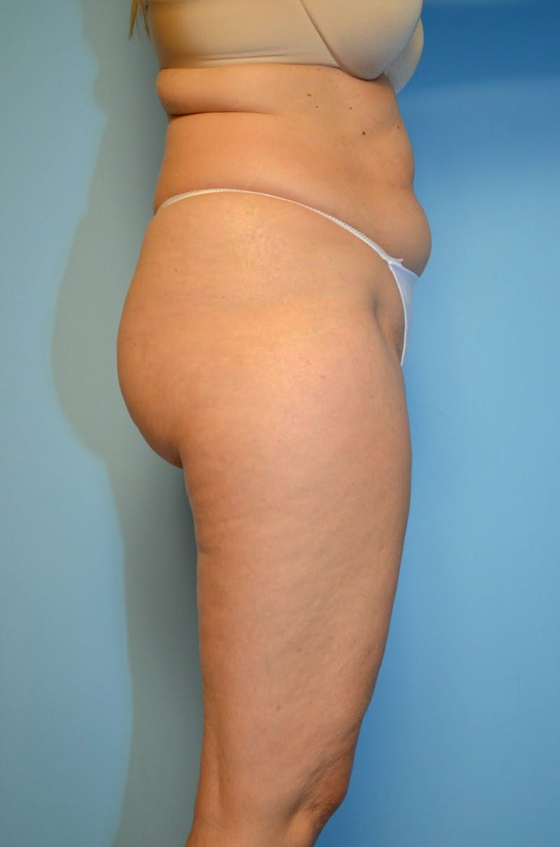Liposuction Before & After Gallery - Patient 986940 - Image 5